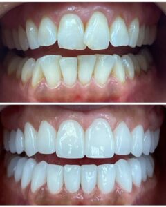 Before After Reference Image 4